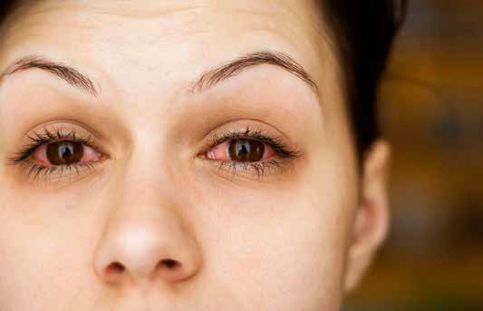 Symptoms of coronavirus pink eye conjunctivitis
