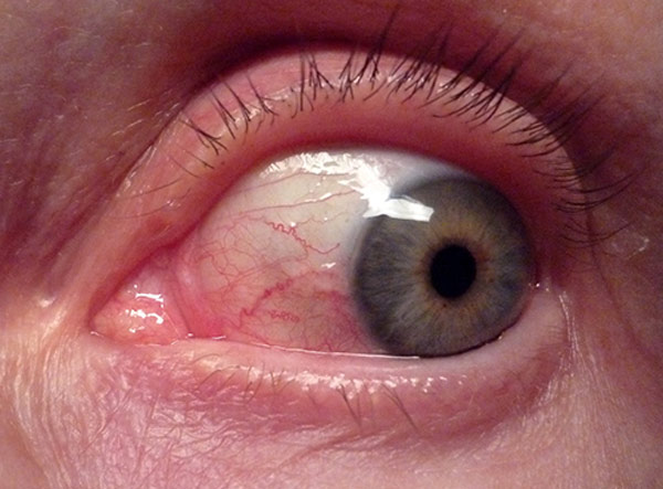Close up of a bloodshot red eye showing irritated blood vessels